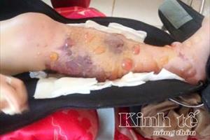 Sở Y tế tỉnh Đắk Lắk họp báo công khai xin lỗi bệnh nhân Lê Thị Hà Vi bị cưa chân